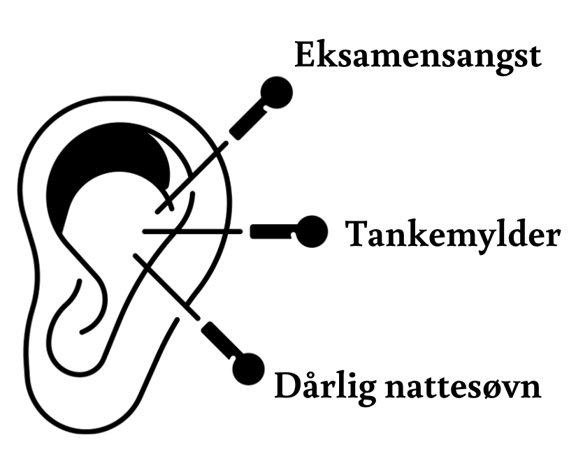 NADA akkupunktur